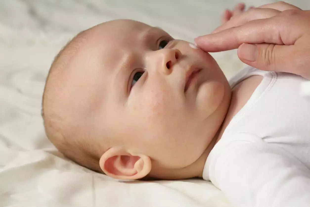 Bebeklerde Egzama: Belirtiler, Nedenler ve Tedavi Yöntemleri